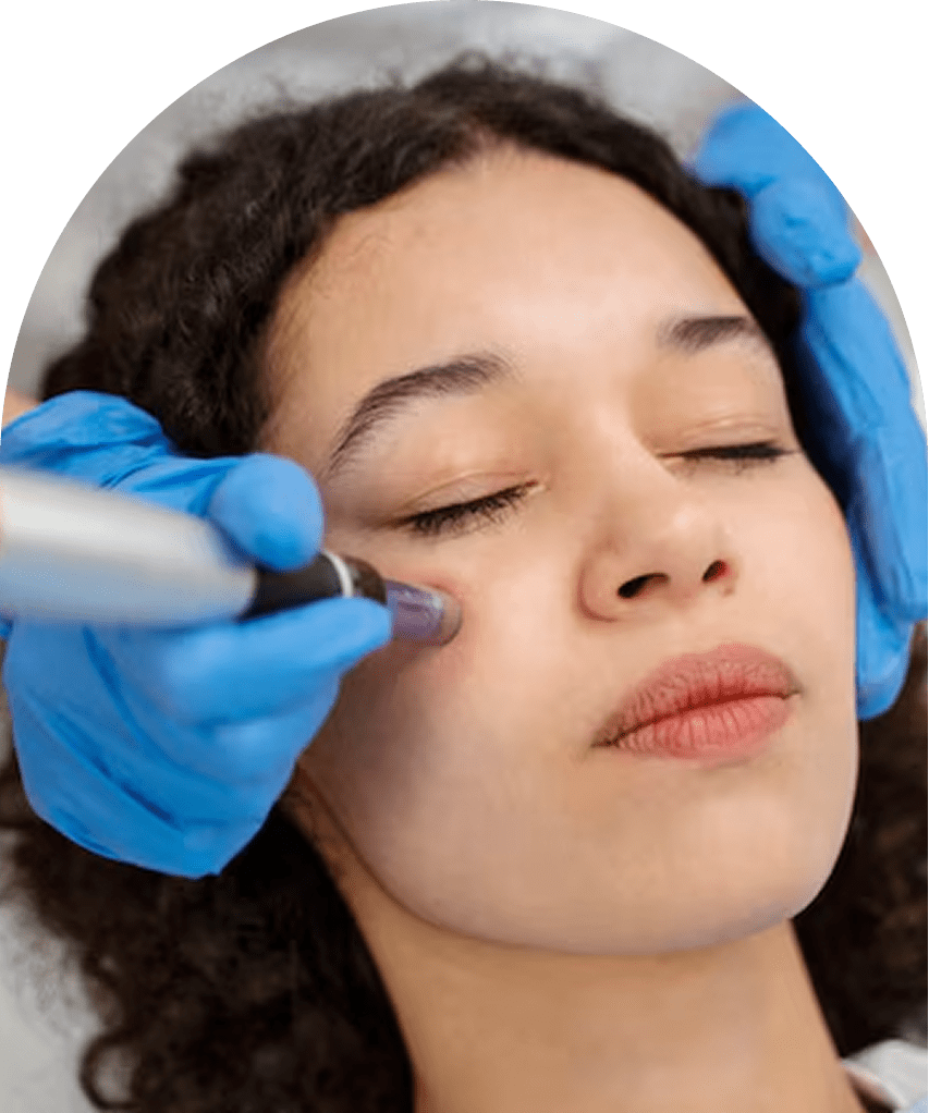 Microneedling